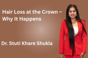 Hair Loss at the Crown – Why It Happens